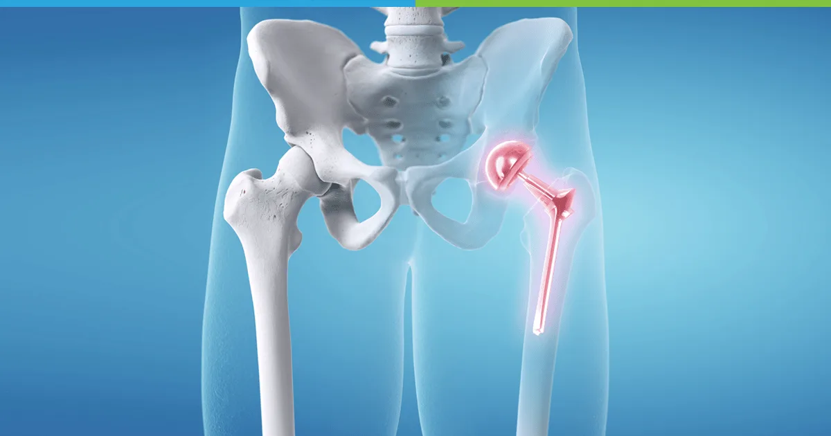 Hip Replacement Surgery Bareilly