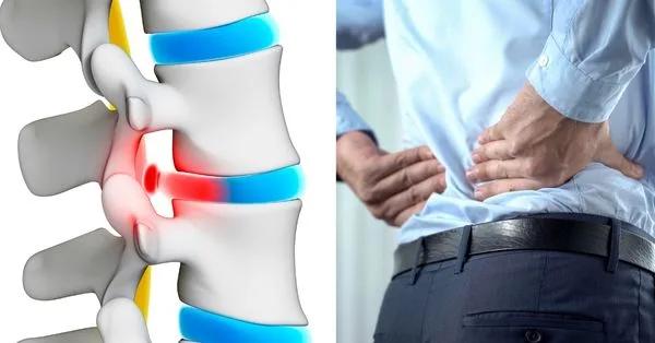 Slip Disc Treatments in Bareilly