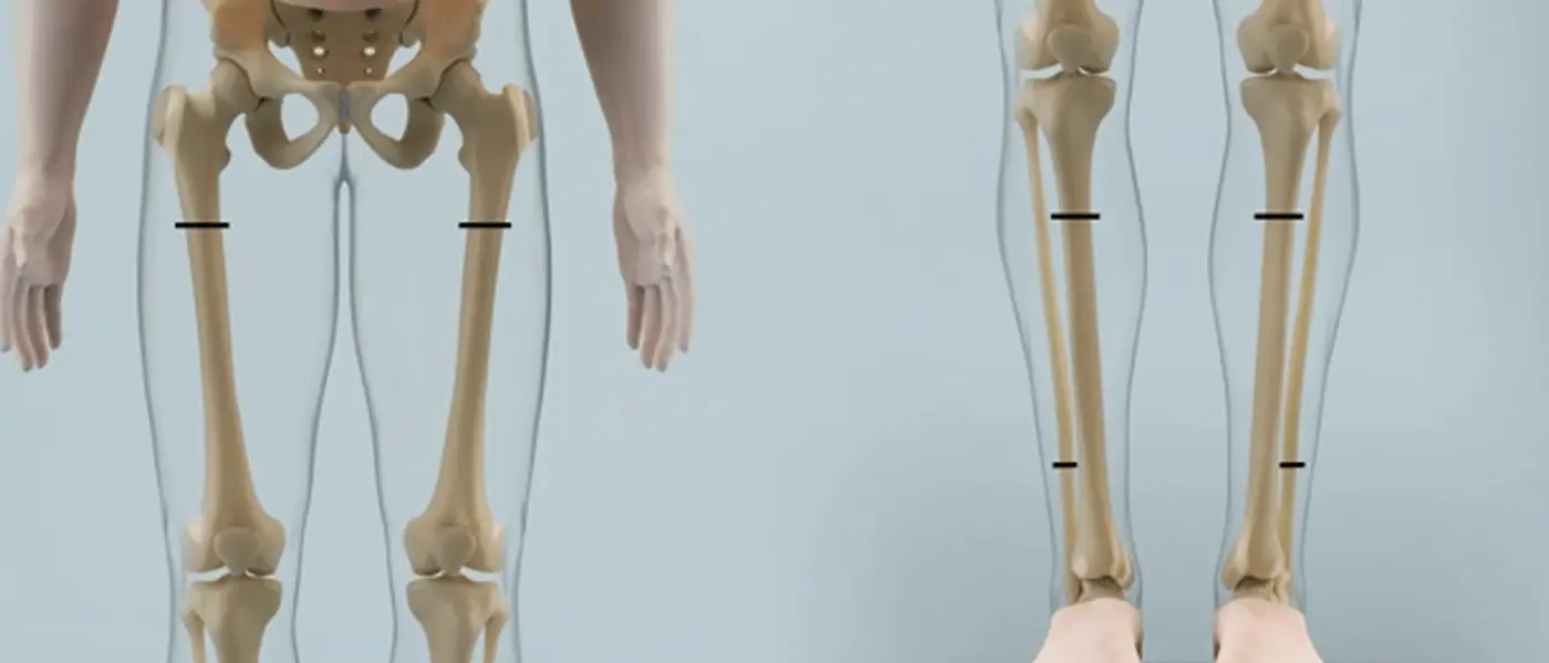 Limb-Lengthening-Treatment-in-India