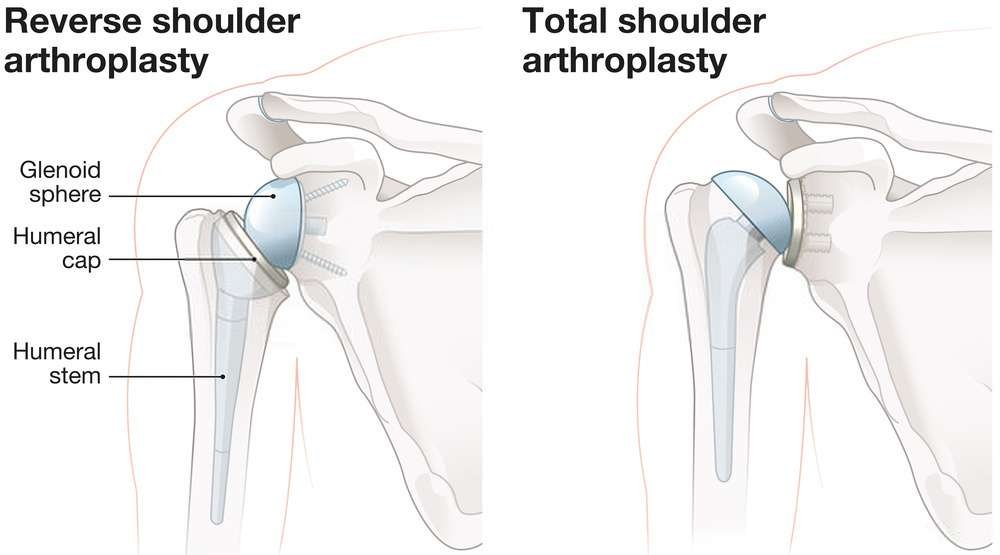 Shoulder-replacement-types