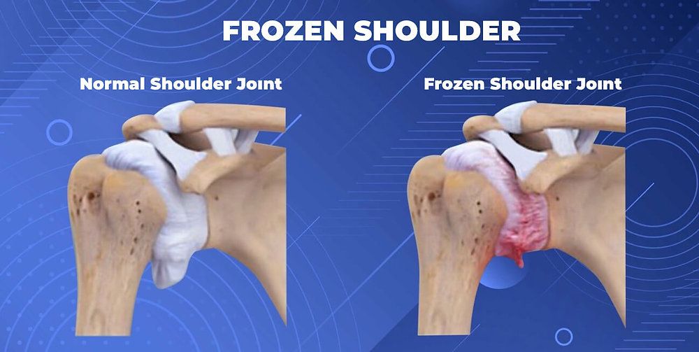 Knee Replacement Surgery
