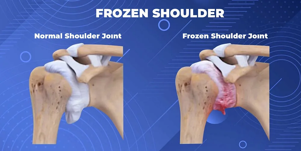 Knee Replacement Surgery